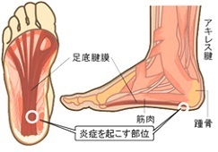 足底筋膜炎（踵骨部痛）
