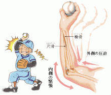 野球肘