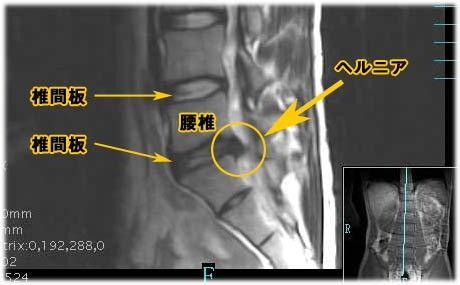 ヘルニア レントゲン で わかる