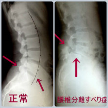 腰椎分離症