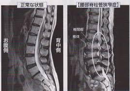 脊柱管狭窄症